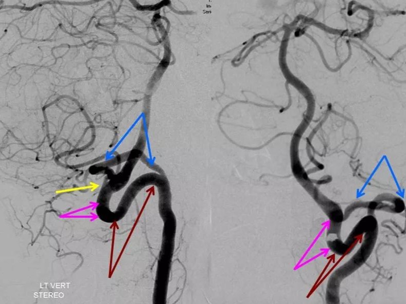 椎基底动脉系统ctmr及dsa影像解剖