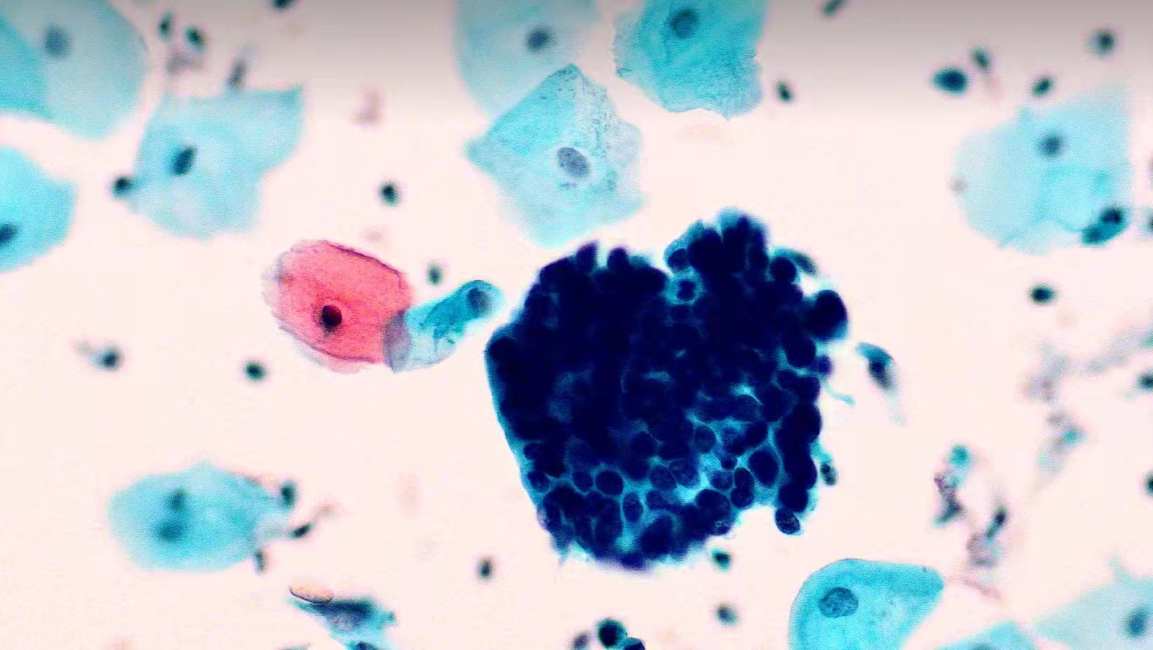 宫颈细胞学检查一例