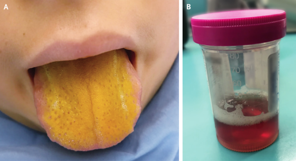 12岁男孩金灿灿的舌头,背后竟隐藏着这种疾病……_医学界-助力医生