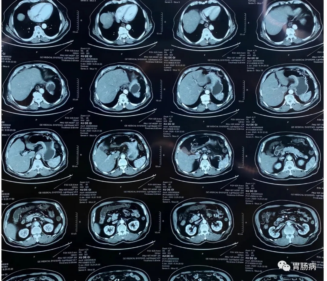 是良性,最终确诊晚期胃癌我曾经写过多篇被漏诊的胃印戒细胞癌的病例