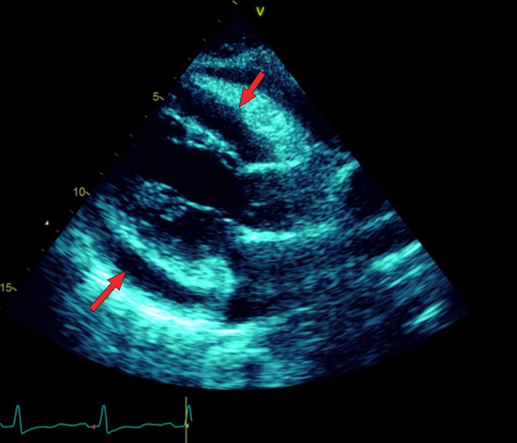 窦性心动过速心包积液增多是缩窄性心包炎还是心包填塞