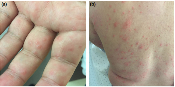 皮损可累及全身,6则病例提示手足口病症状可能并不典型!