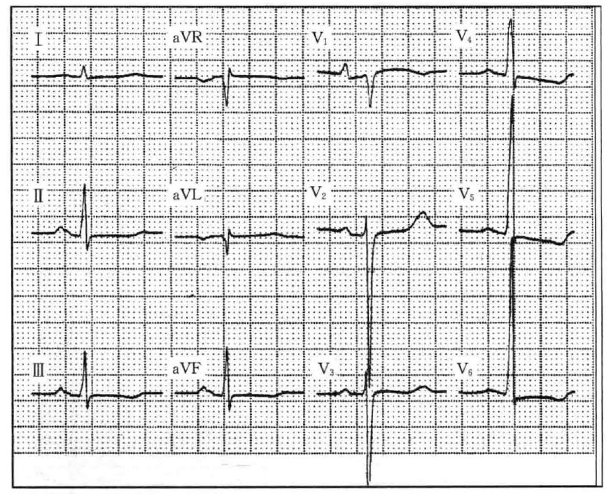 如图所示,p波在i,ii,avf,胸前各导联直立向上,avr导联向下,示心房激动