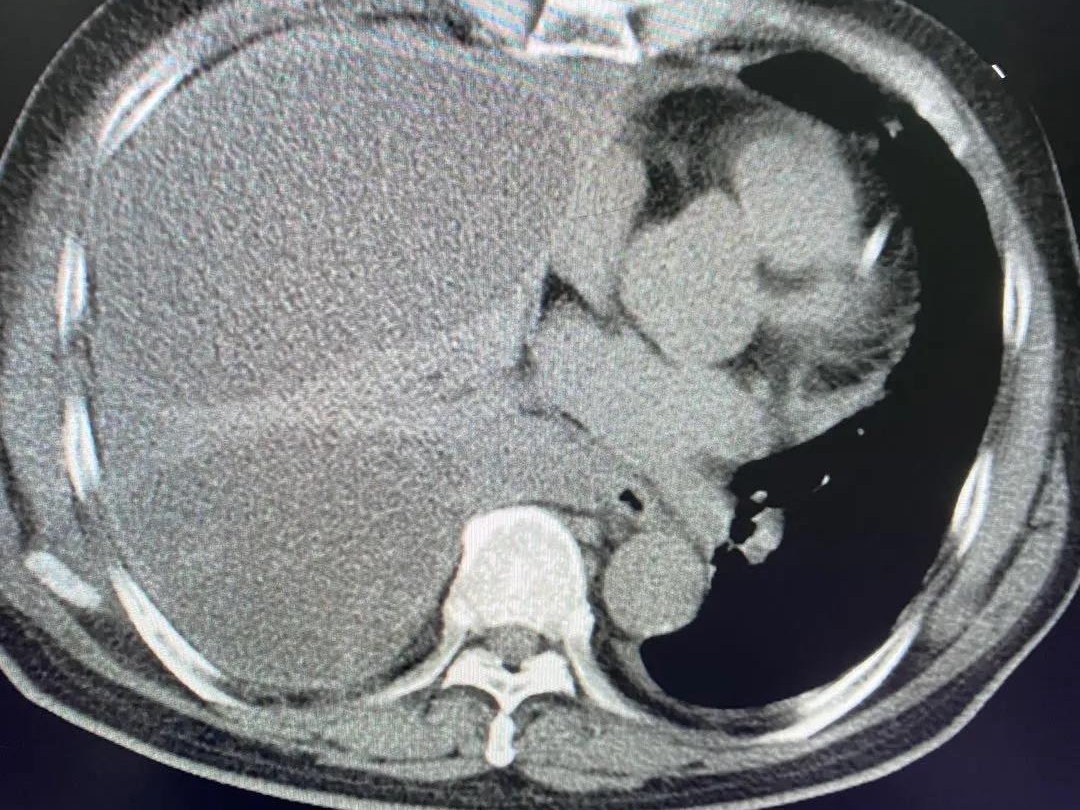 医学科普‖气管CT三维重建，精准显示气管异物及气道相关病变_影像