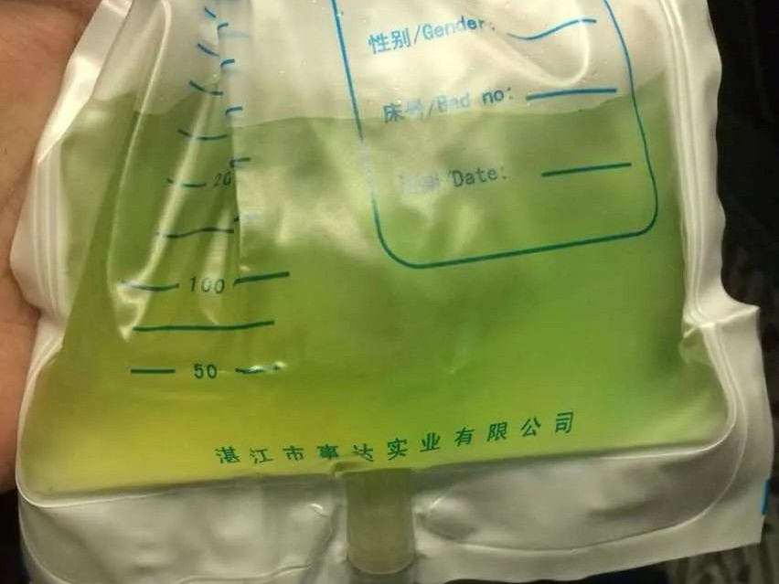 「绿色尿液」,你见过吗？