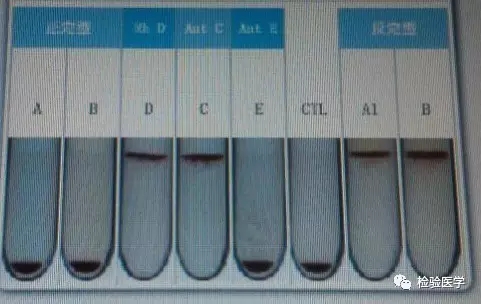 一眼望穿多发性骨髓瘤病友的交叉配血疑云