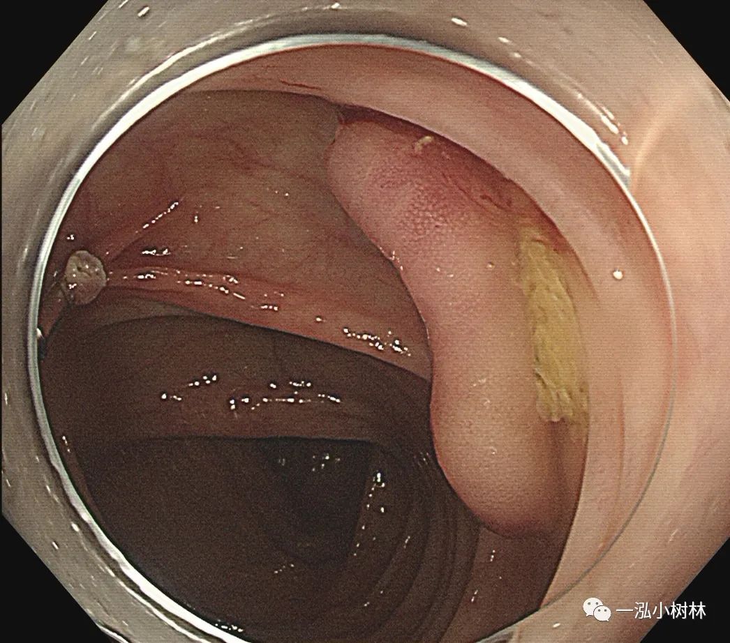 横结肠黏膜下拉长型息肉_医学界-助力医生临床决策和职业成长