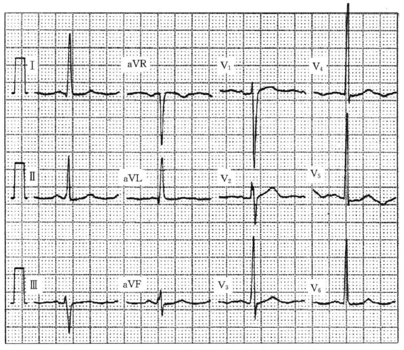 「有奖问答」患者高血压10年，发作性心前区痛2月余，心电图有何异常？_医学界-助力医生临床决策和职业成长